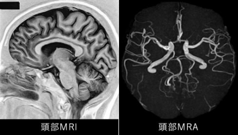 頭部MRI検査 頭部MRA検査