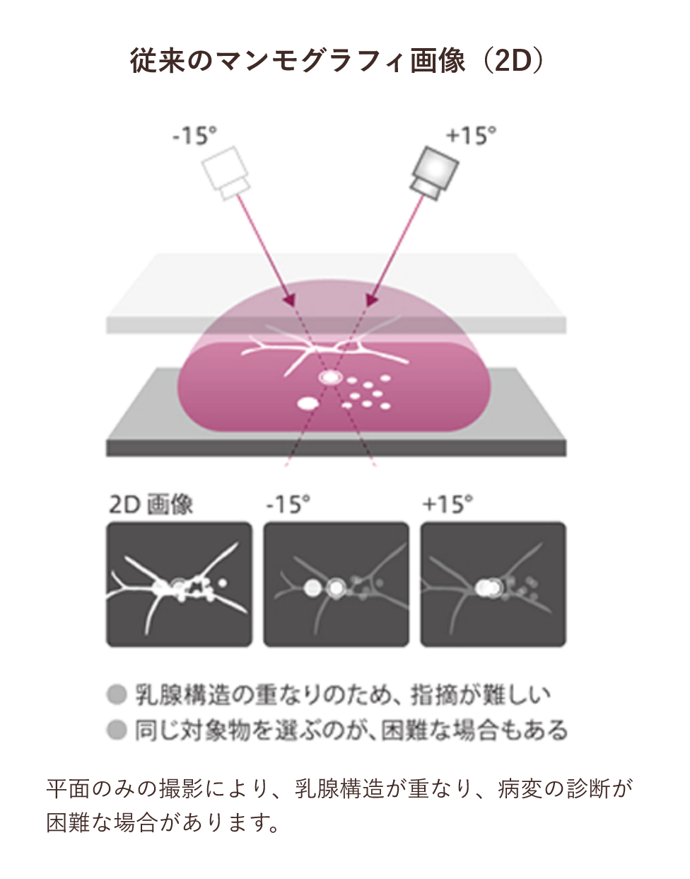 従来のマンモグラフィ画像（2D）